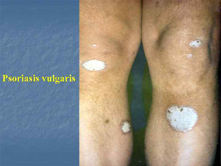 Psoriasis vulgaris 