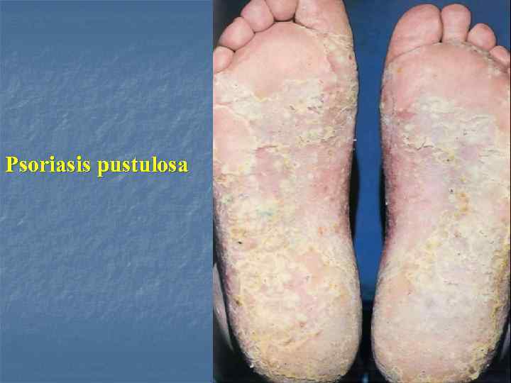 Psoriasis pustulosa 