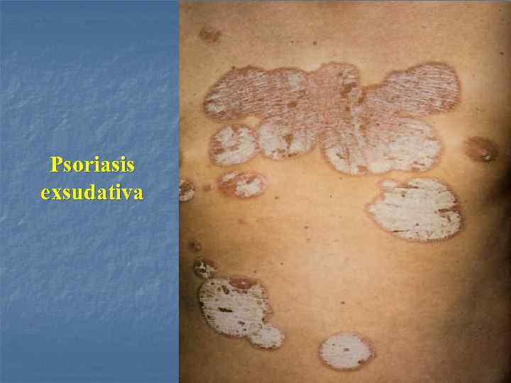 Psoriasis exsudativa 