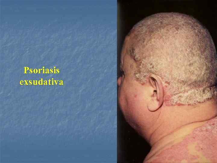 Psoriasis exsudativa 