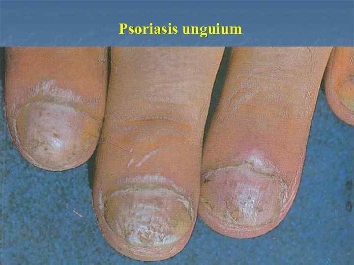 Psoriasis unguium 