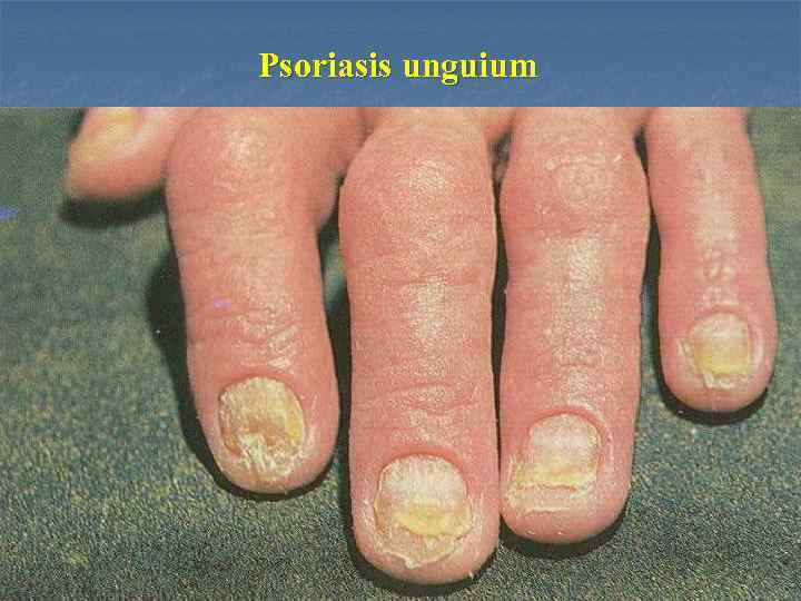 Psoriasis unguium 
