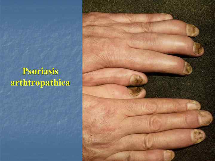 Psoriasis arthtropathica 
