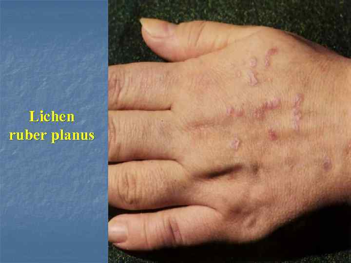 Lichen ruber planus 