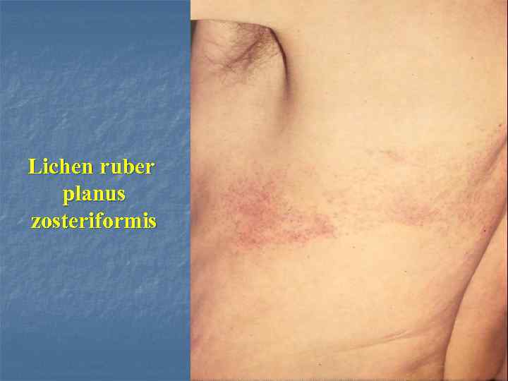 Lichen ruber planus zosteriformis 