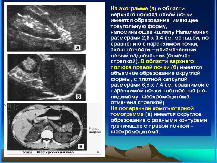 Вторичная гипертензия карта вызова