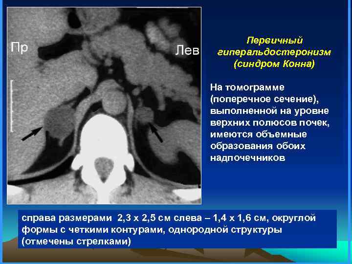 Первичный гиперальдостеронизм презентация