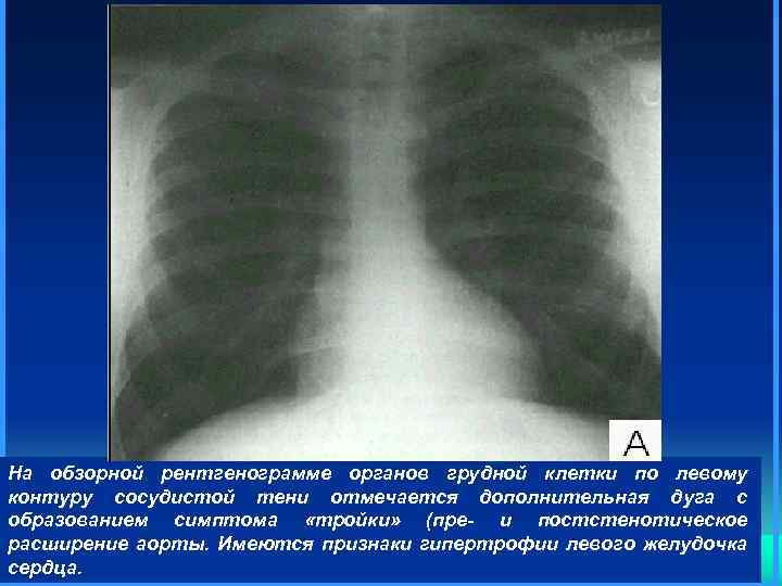 На обзорной рентгенограмме органов грудной клетки по левому контуру сосудистой тени отмечается дополнительная дуга
