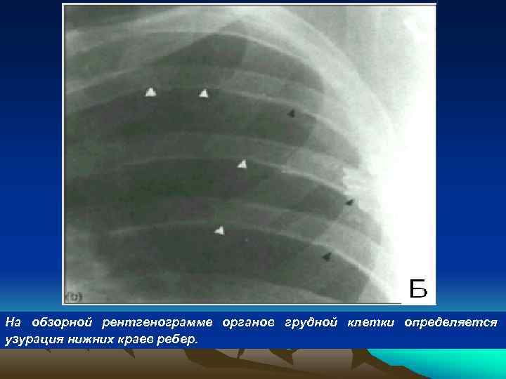На обзорной рентгенограмме органов грудной клетки определяется узурация нижних краев ребер. 