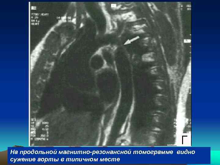 На продольной магнитно-резонансной томограмме видно сужение аорты в типичном месте 