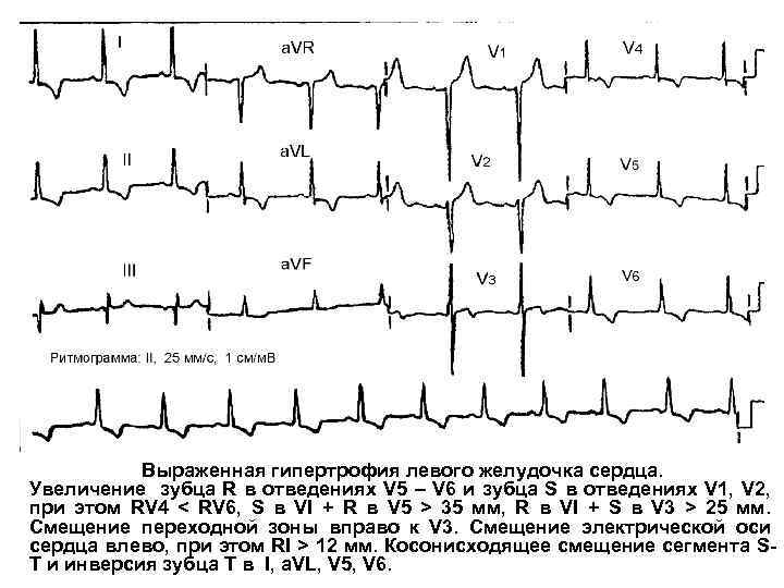 Выраженная гипертрофия левого желудочка сердца. Увеличение зубца R в отведениях V 5 – V