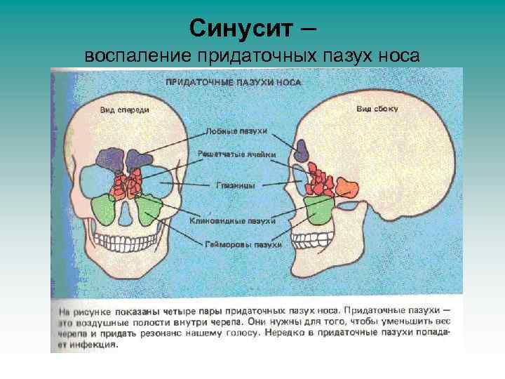 Синусит – воспаление придаточных пазух носа 