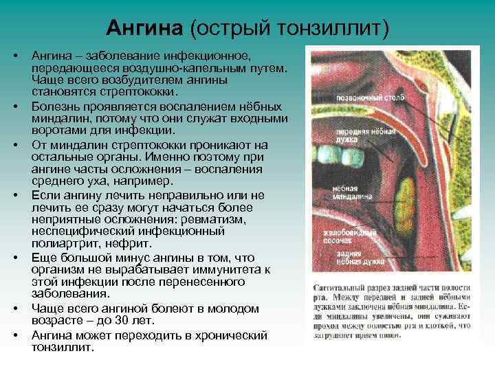 Ангина (острый тонзиллит) • • Ангина – заболевание инфекционное, передающееся воздушно-капельным путем. Чаще всего