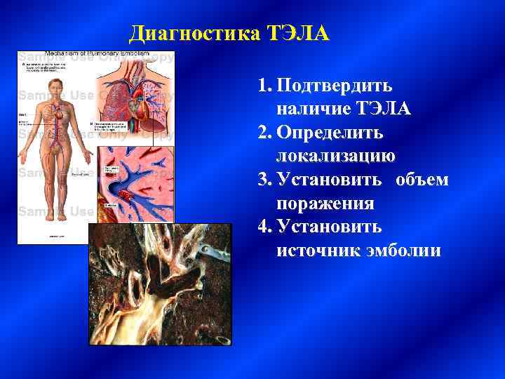 Диагностика ТЭЛА 1. Подтвердить наличие ТЭЛА 2. Определить локализацию 3. Установить объем поражения 4.