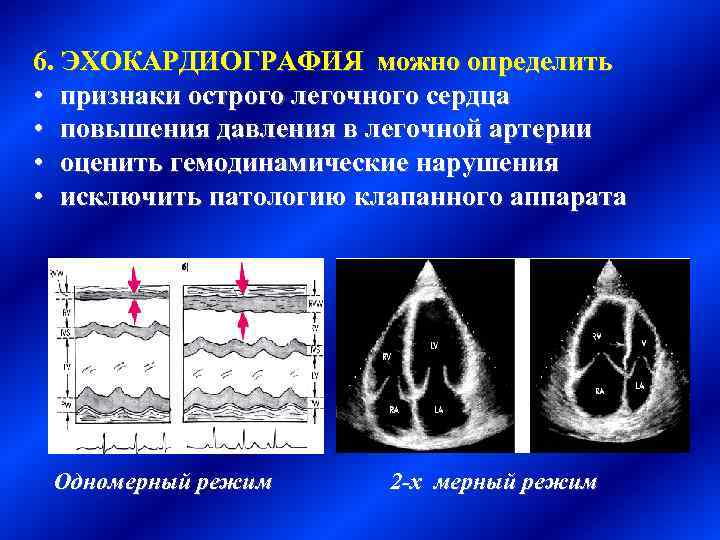 6. ЭХОКАРДИОГРАФИЯ можно определить • признаки острого легочного сердца • повышения давления в легочной