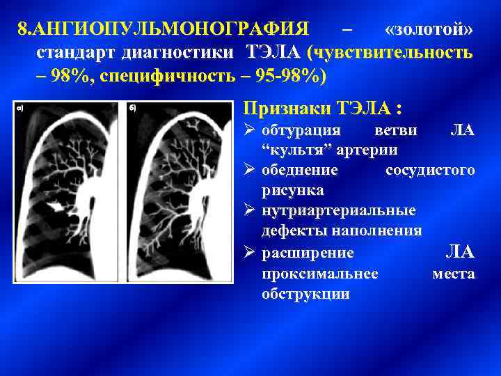 Обеднение сосудистого рисунка легких характерно для