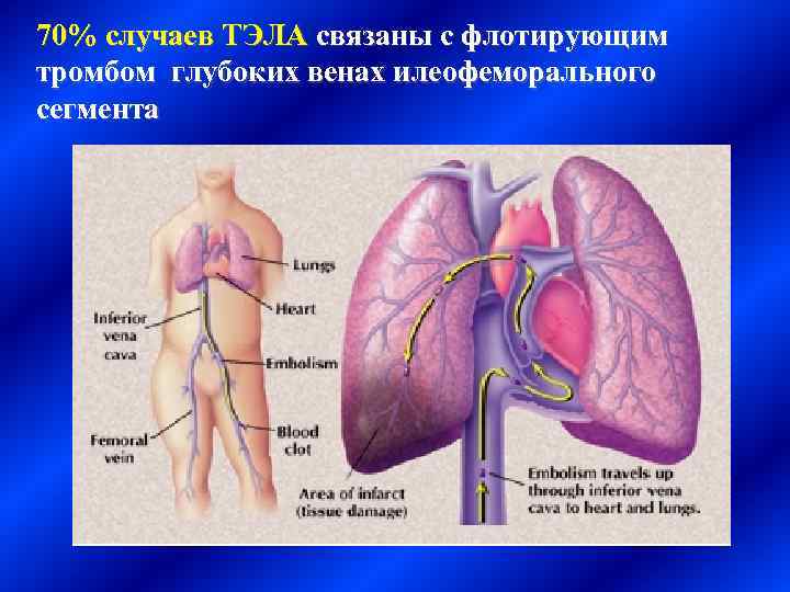 70% случаев ТЭЛА связаны с флотирующим тромбом глубоких венах илеофеморального сегмента 