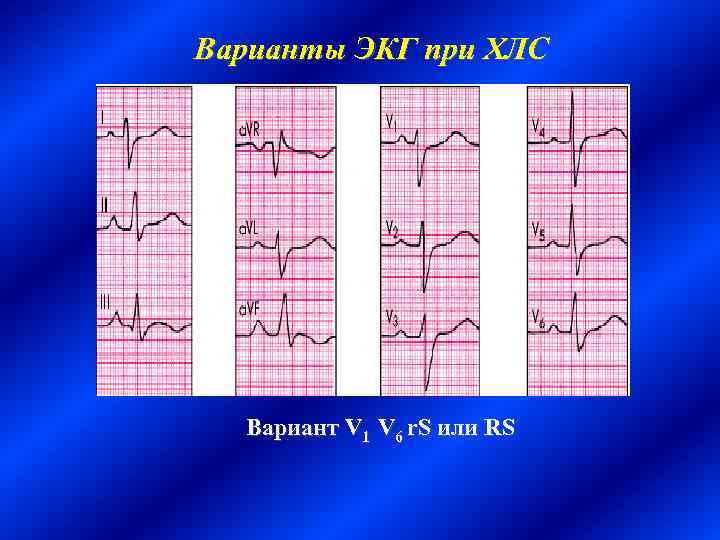 Варианты экг