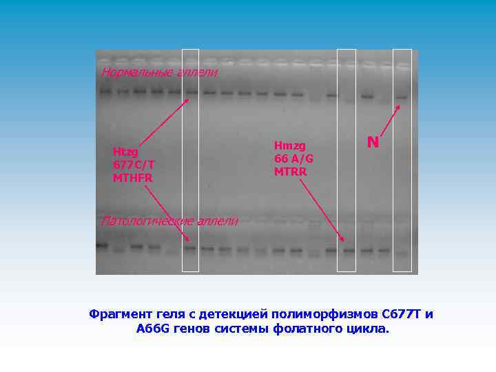 Нормальные аллели Htzg 677 C/T MTHFR Hmzg 66 A/G MTRR N Патологические аллели Фрагмент