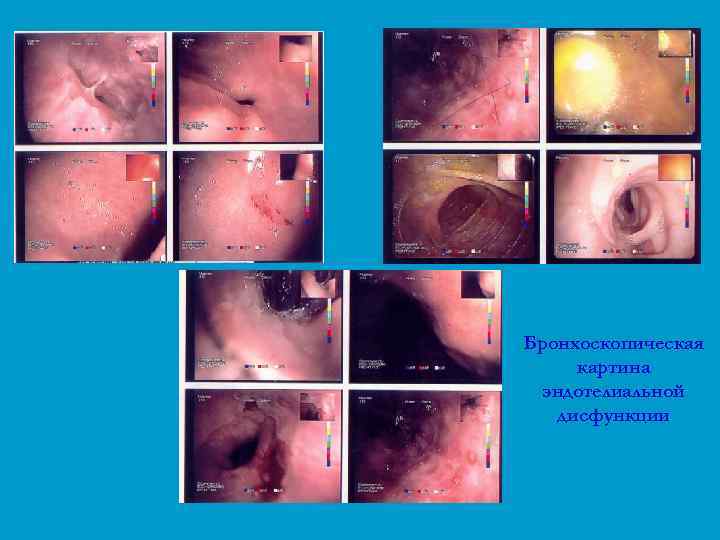 Бронхоскопическая картина эндотелиальной дисфункции 