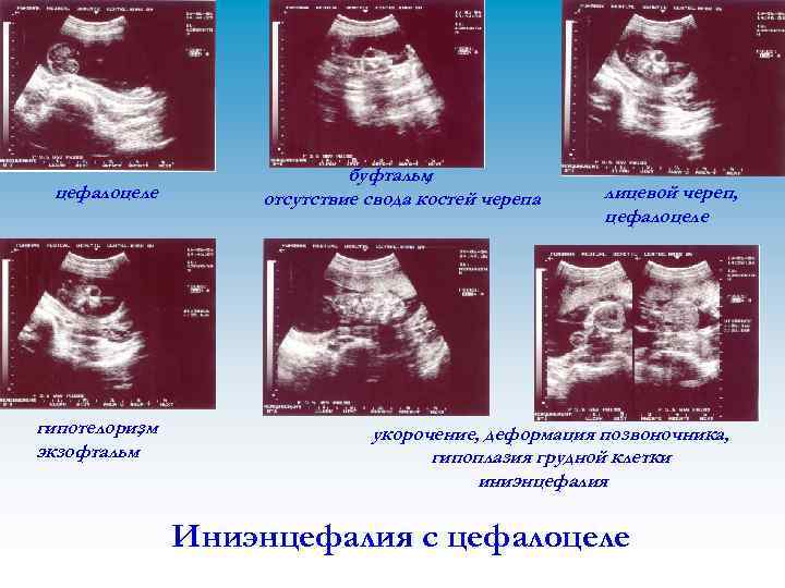 цефалоцеле гипотелоризм , экзофтальм буфтальм , отсутствие свода костей черепа лицевой череп, цефалоцеле укорочение,