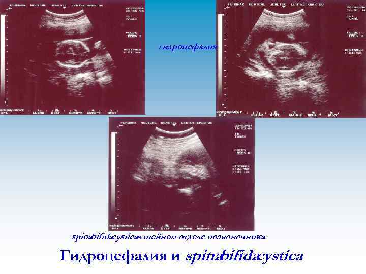 гидроцефалия spinabifidacysticaв шейном отделе позвоночника Гидроцефалия и spinabifidacystica 