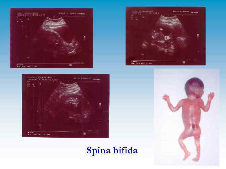 Spina bifida 