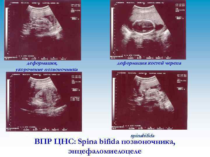 деформация, укорочение позвоночника гипоплазия, дисплазия почек деформация костей черепа spinabifida ВПР ЦНС: Spina bifida