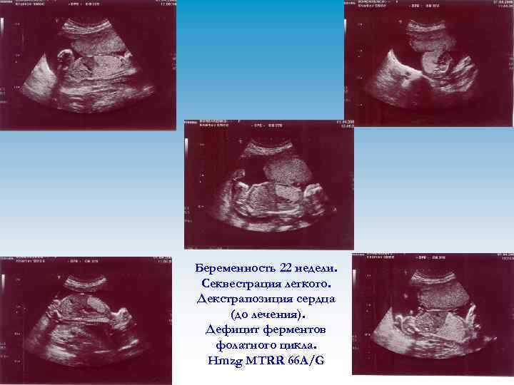 Беременность 22 недели. Секвестрация легкого. Декстрапозиция сердца (до лечения). Дефицит ферментов фолатного цикла. Hmzg