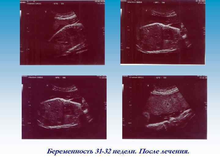 Беременность 31 -32 недели. После лечения. 