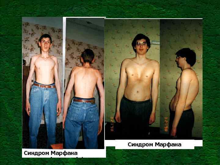 Синдром Марфана 