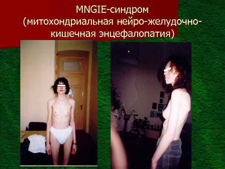 MNGIE-синдром (митохондриальная нейро-желудочнокишечная энцефалопатия) 