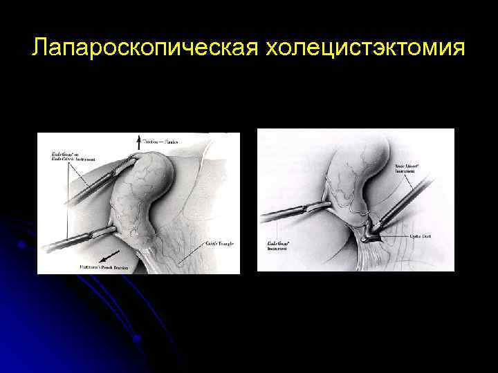 Лапароскопическая холецистэктомия 