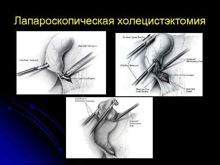 Лапароскопическая холецистэктомия 