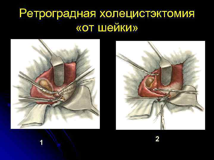 Ретроградная холецистэктомия «от шейки» 1 2 