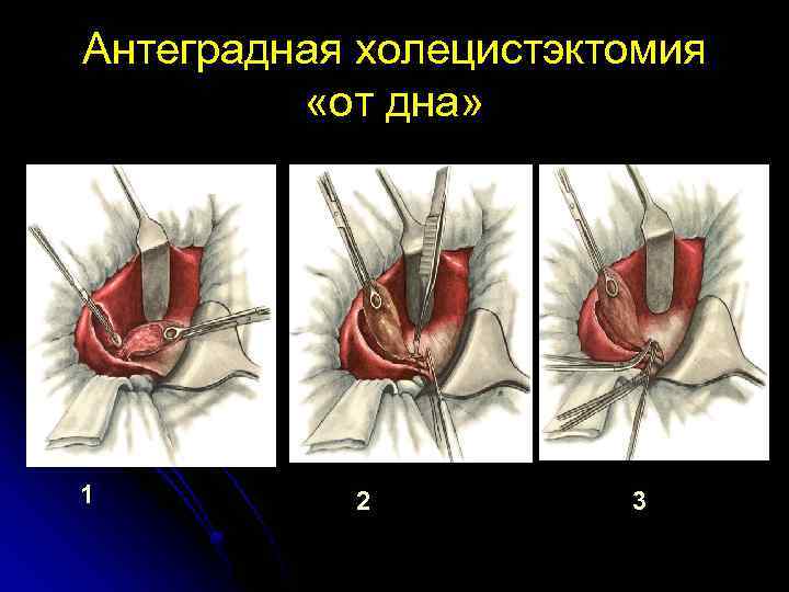 Острый холецистит карта вызова скорой