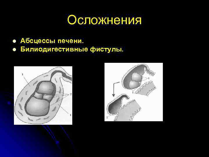 Осложнения l l Абсцессы печени. Билиодигестивные фистулы. 