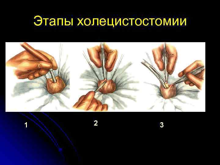 Этапы холецистостомии 1 2 3 