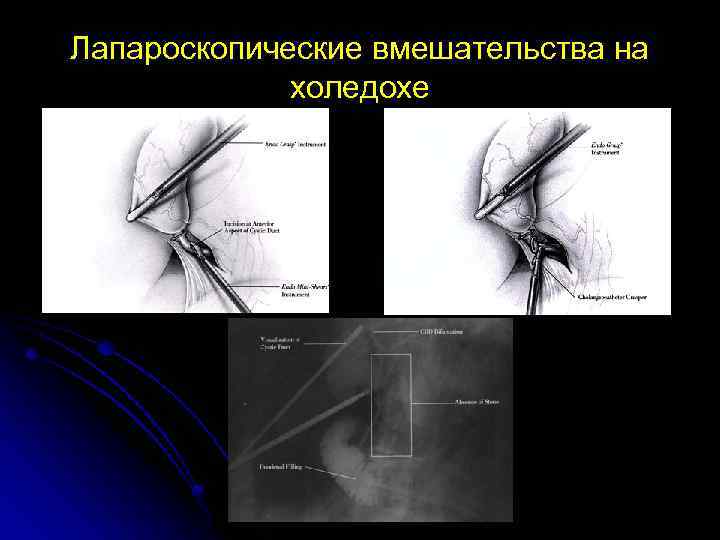 Лапароскопические вмешательства на холедохе 