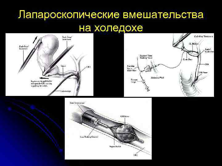 Холецистит презентация по хирургии