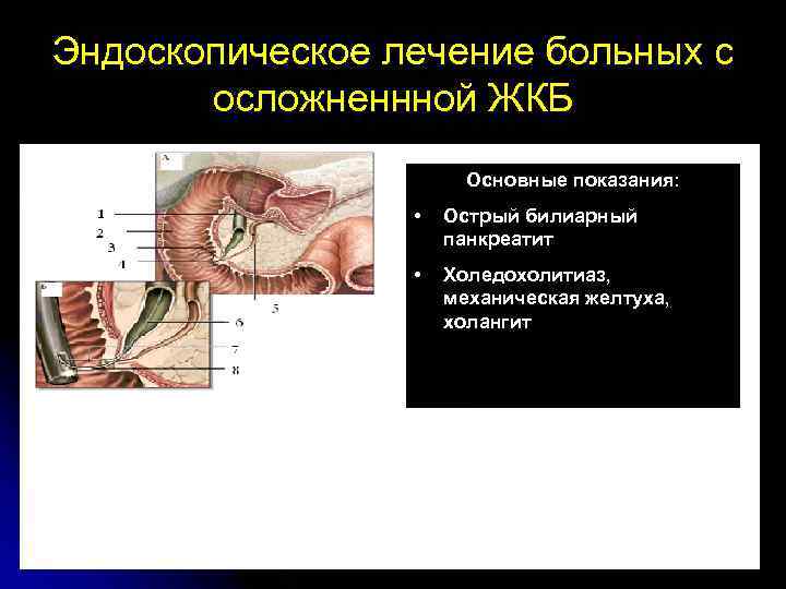 Эндоскопическое лечение больных с осложненнной ЖКБ Основные показания: • Острый билиарный панкреатит • Холедохолитиаз,