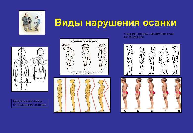 Как называется нарушение осанки изображенное на рисунке 2