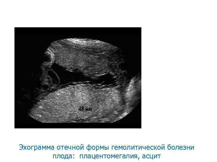 Эхограмма отечной формы гемолитической болезни плода: плацентомегалия, асцит 