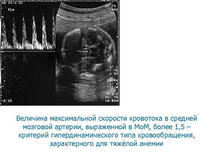 Величина максимальной скорости кровотока в средней мозговой артерии, выраженной в Мо. М, более 1,