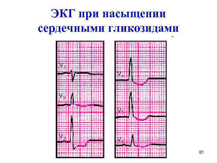 ЭКГ при насыщении сердечными гликозидами 81 