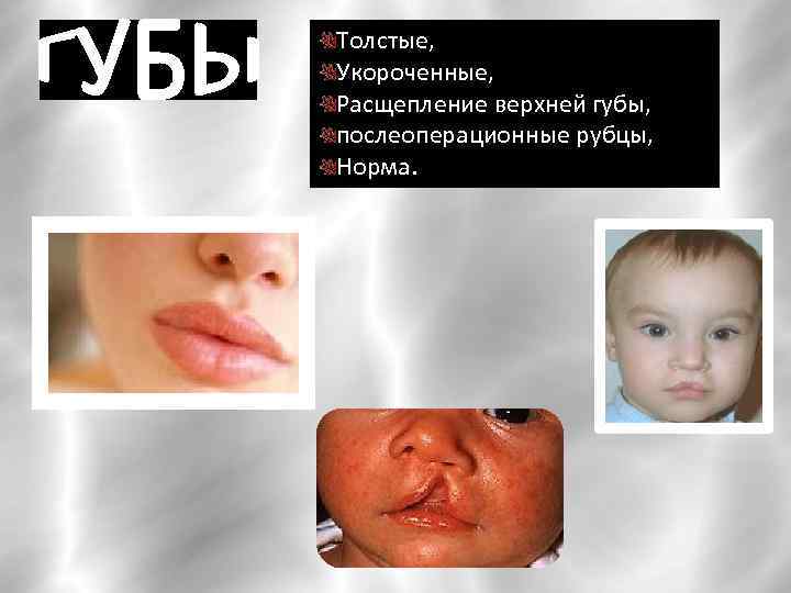 Толстые, Укороченные, Расщепление верхней губы, послеоперационные рубцы, Норма. 