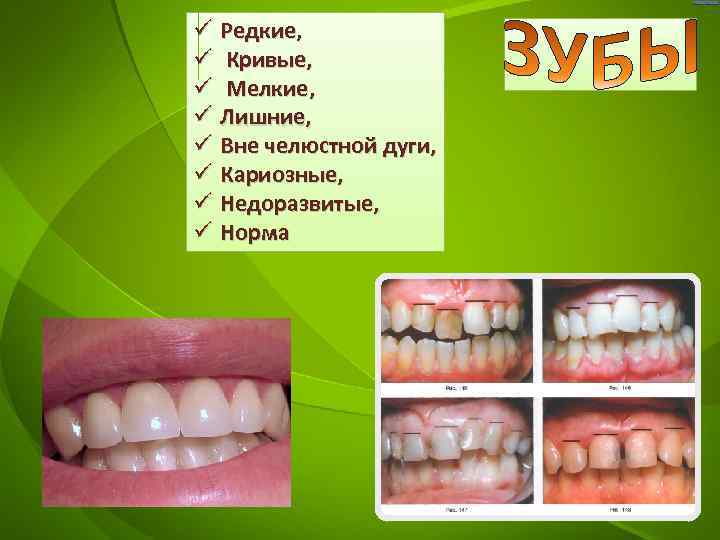 ü Редкие, ü Кривые, ü Мелкие, ü Лишние, ü Вне челюстной дуги, ü Кариозные,