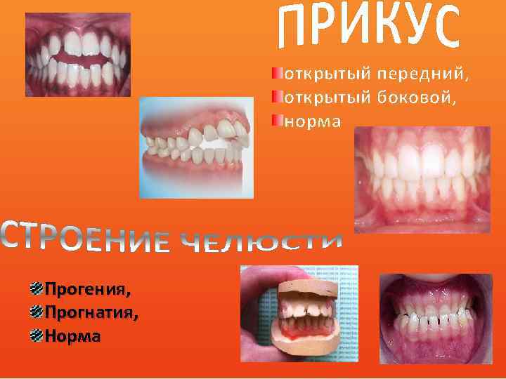 Нормальный прикус. Открытый прикус в логопедии. Передний прикус в логопедии.