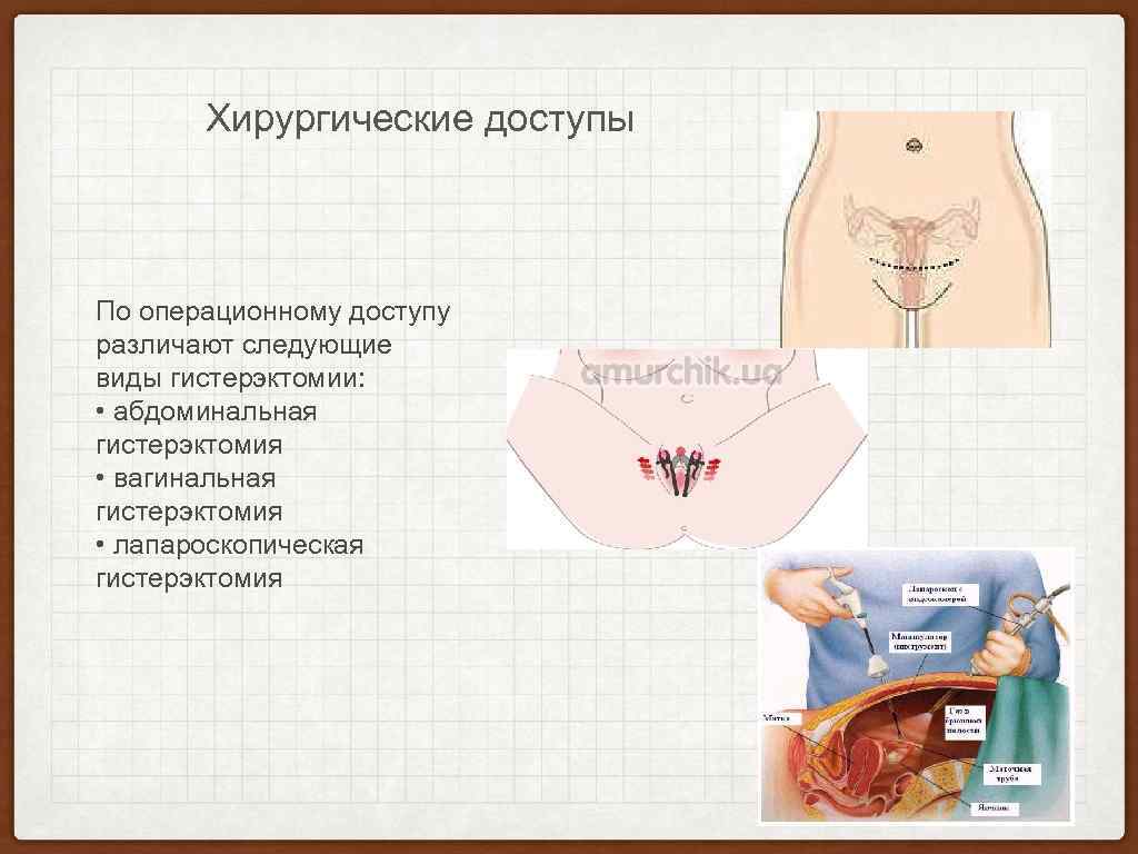 Хирургические доступы По операционному доступу различают следующие виды гистерэктомии: • абдоминальная гистерэктомия • вагинальная