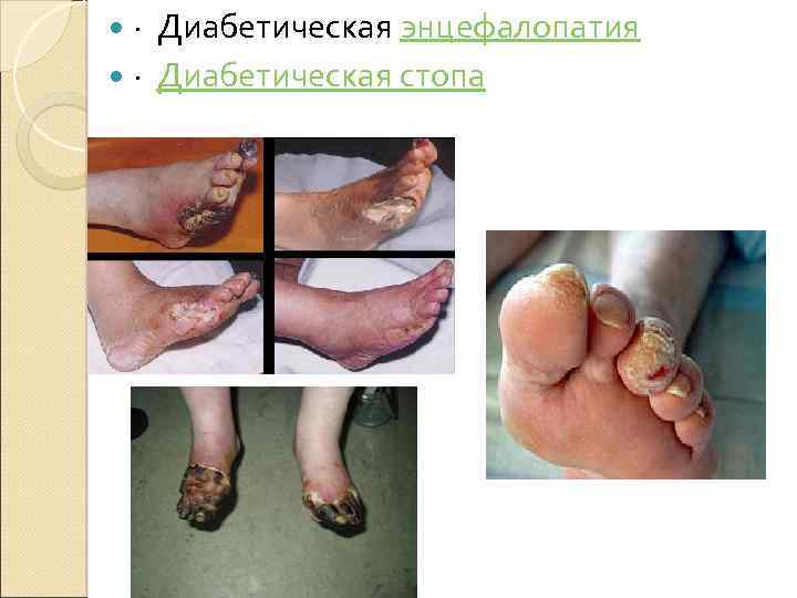  · Диабетическая энцефалопатия · Диабетическая стопа 
